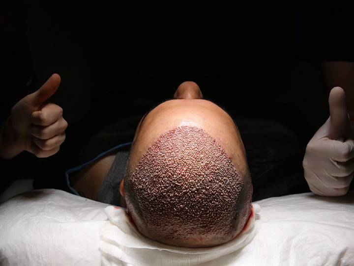 عفونت پس از کاشت مو